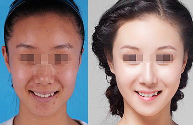 熱拉提的治療效果好不好？多久起效？